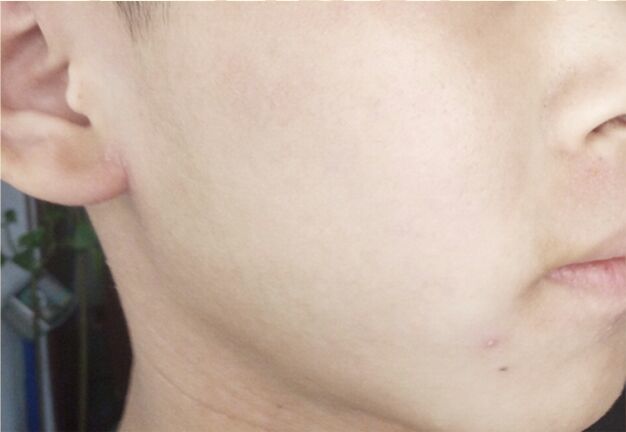 面部颈部湿疹 皮炎三年余(图3)