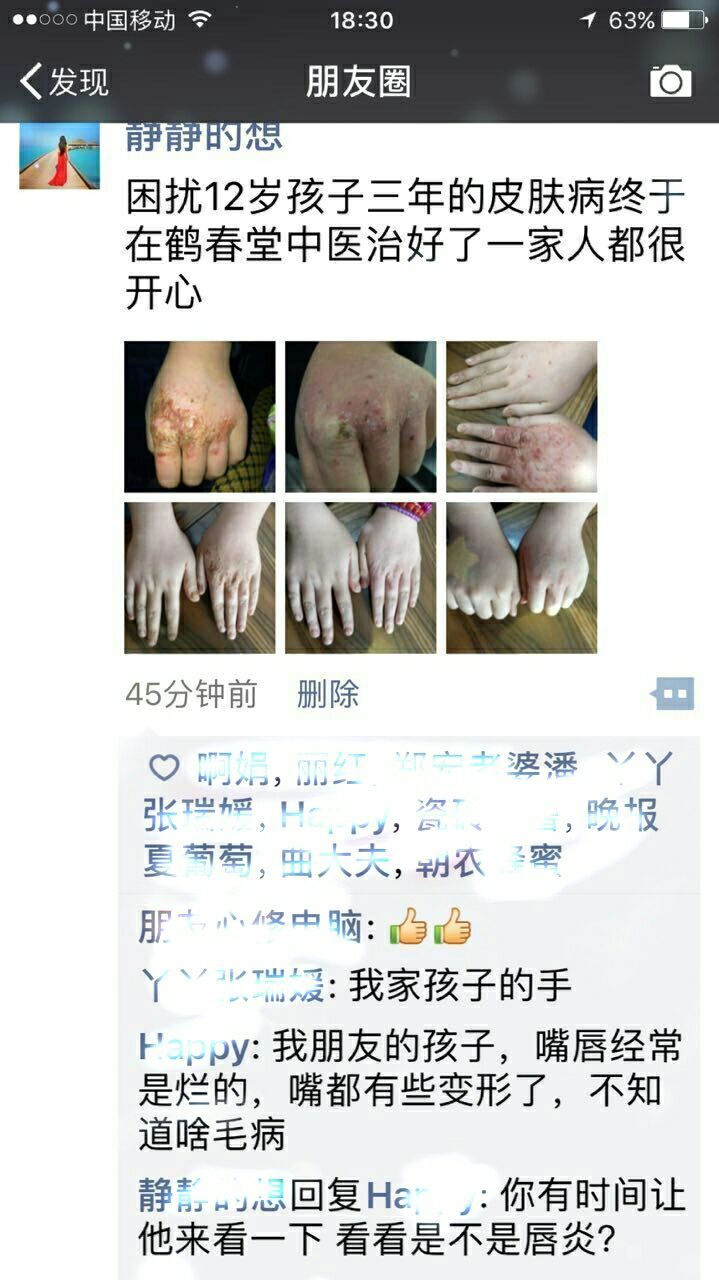 手部皲裂性湿疹三年(图1)