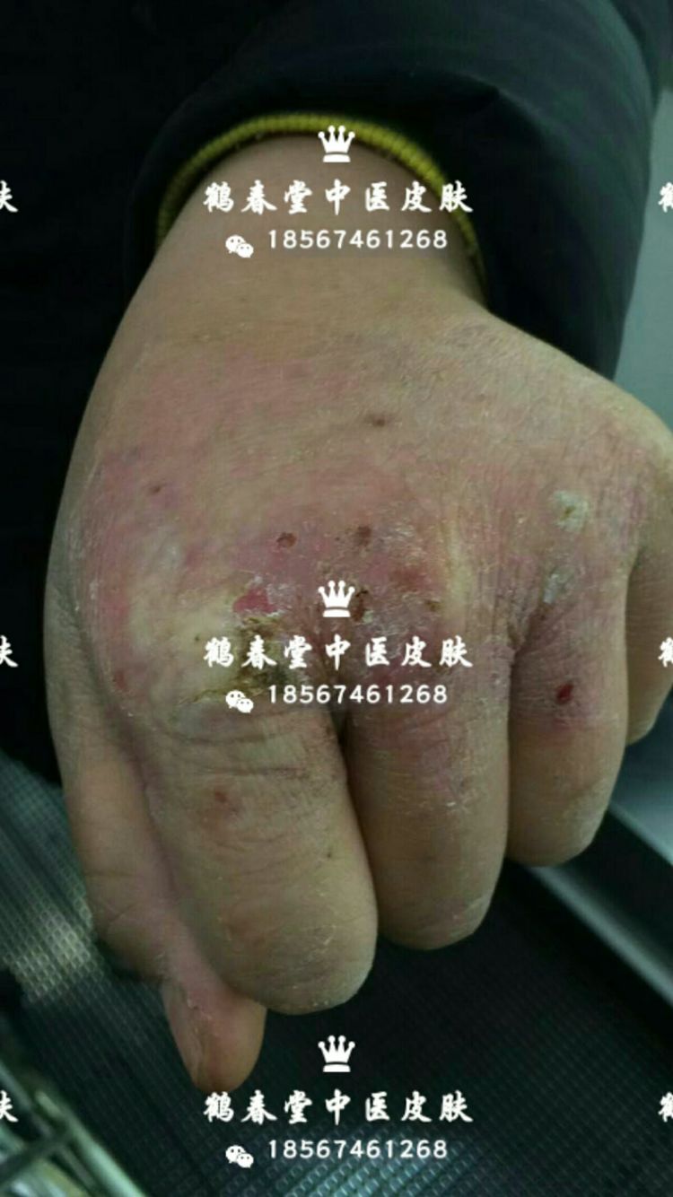 手部皲裂性湿疹三年(图2)