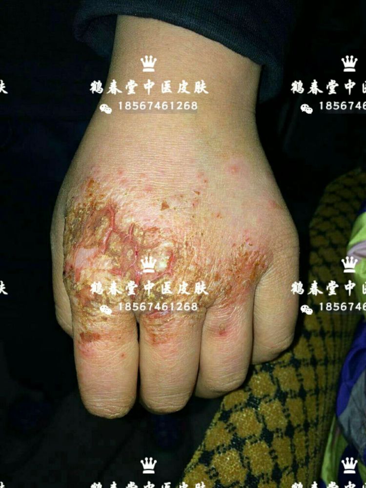 手部皲裂性湿疹三年(图3)
