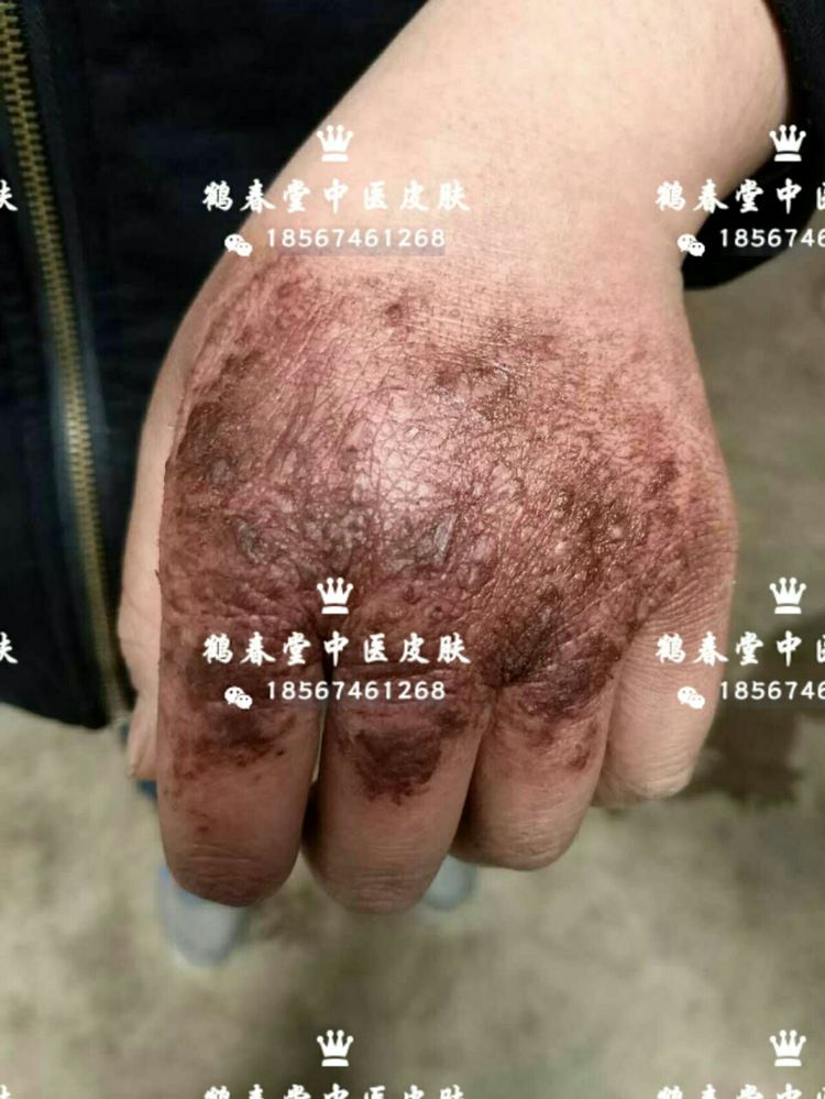 手部皲裂性湿疹三年(图4)