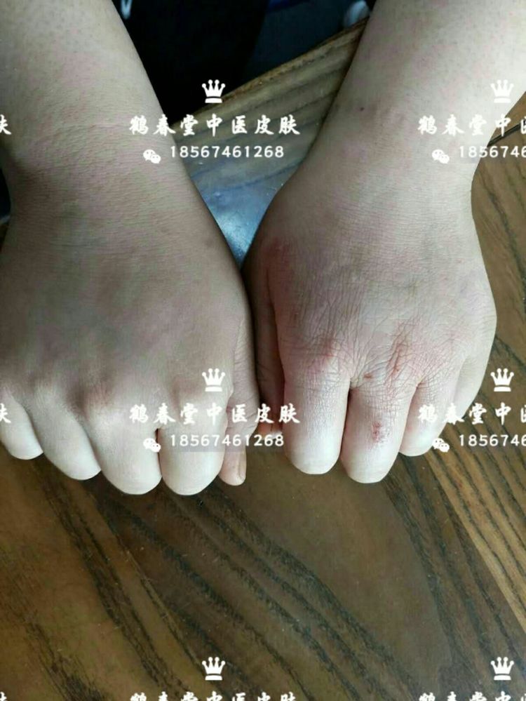 手部皲裂性湿疹三年(图5)